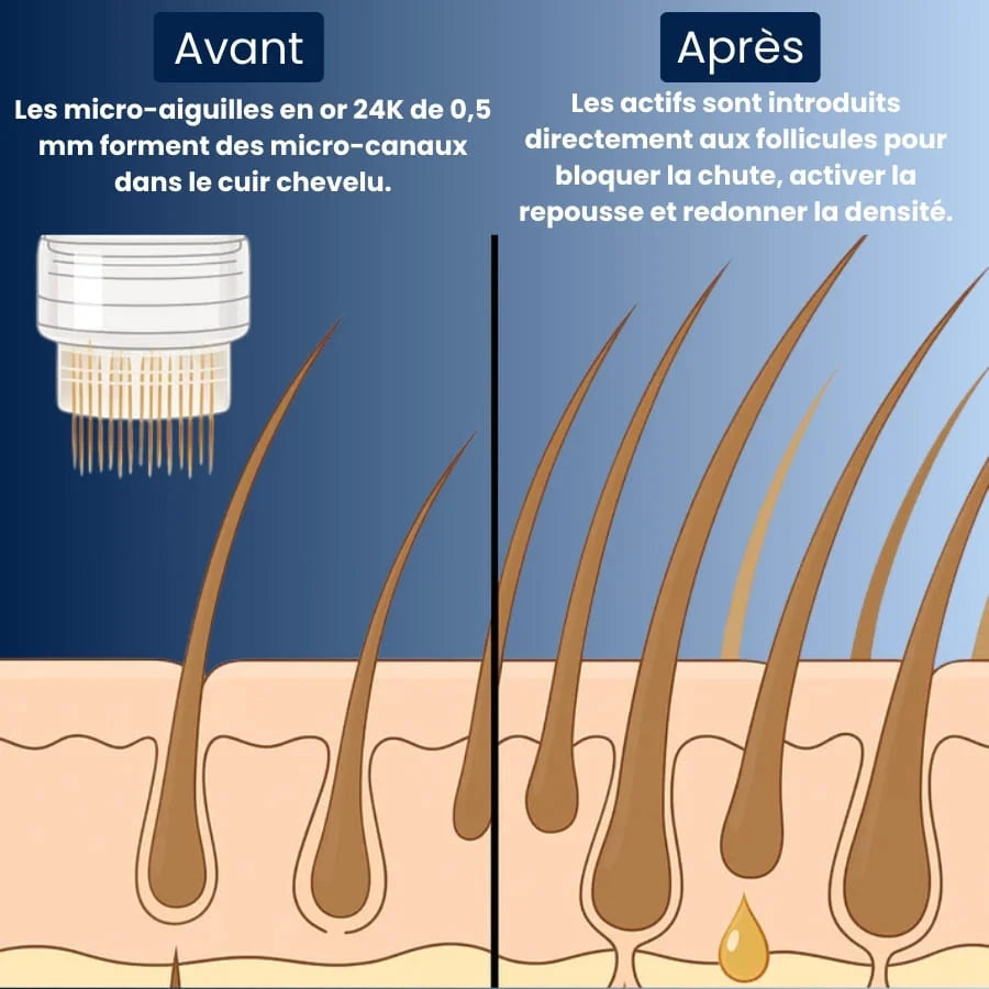Technologie Micro Infusion™ Capillaire